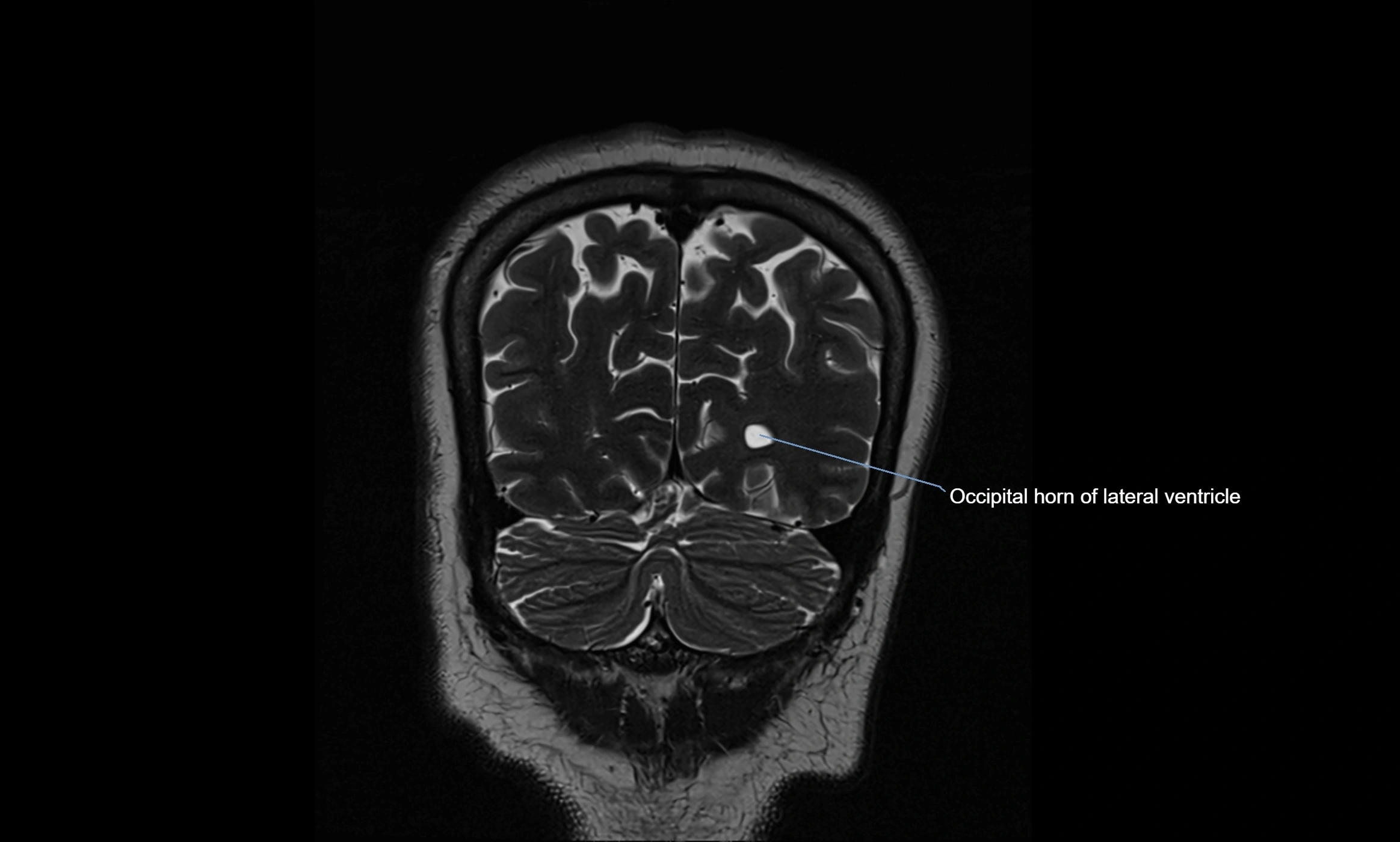 Brain cisterns  and ventricles coronal anatomy 3T MRI image-img-00001-00053.webp